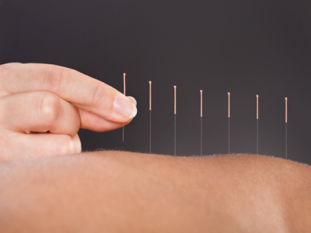 Dry-Needling